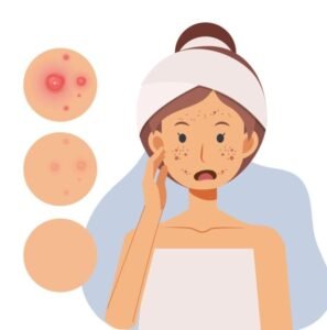 Natural Face Care For Acne: Best Organic Remedies For Clear, Healthy ...
