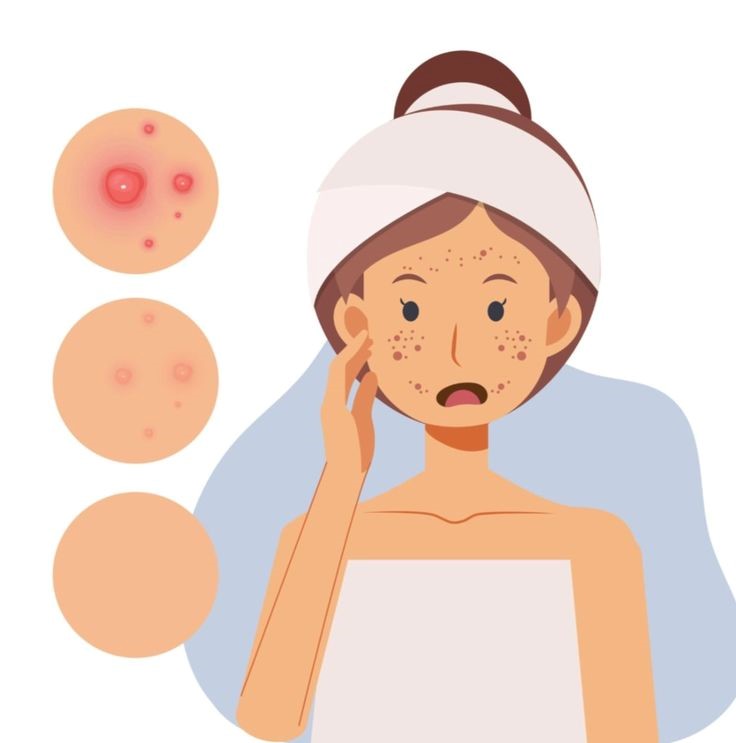 root of acne