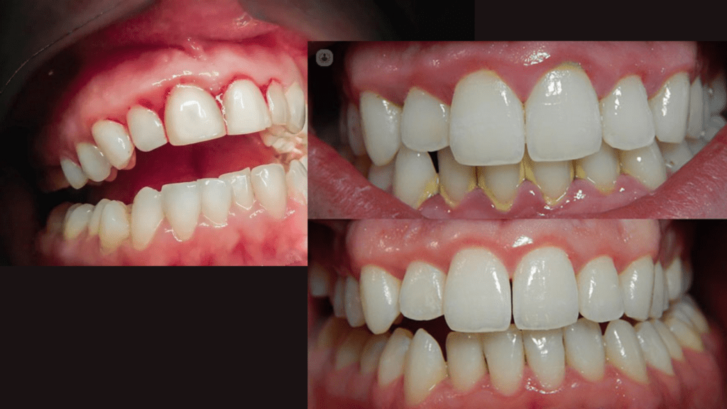 Image showing Gingivitis Stage of Gum Disease