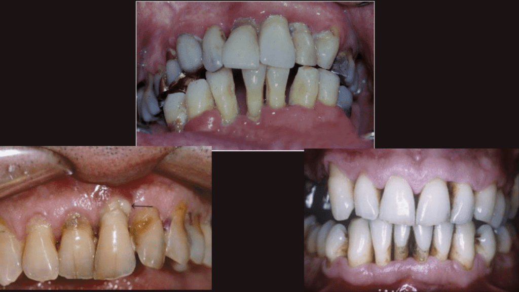 Image showing Periodontitis Stage of Gum Disease