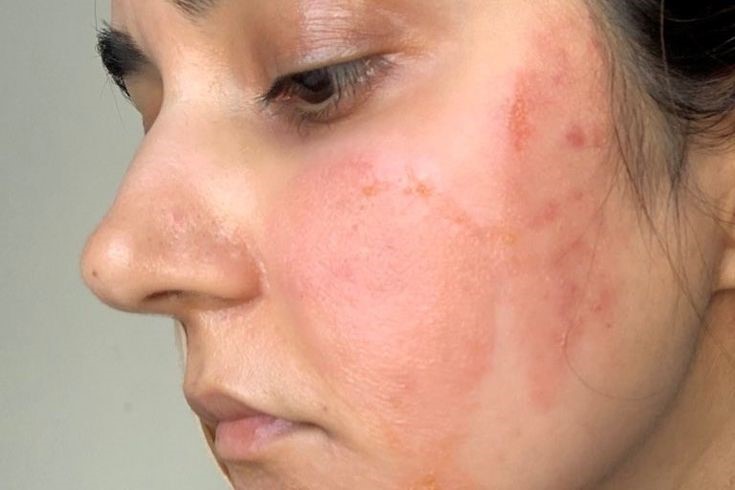 face burning