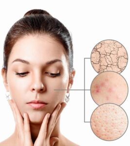 Dry Skin