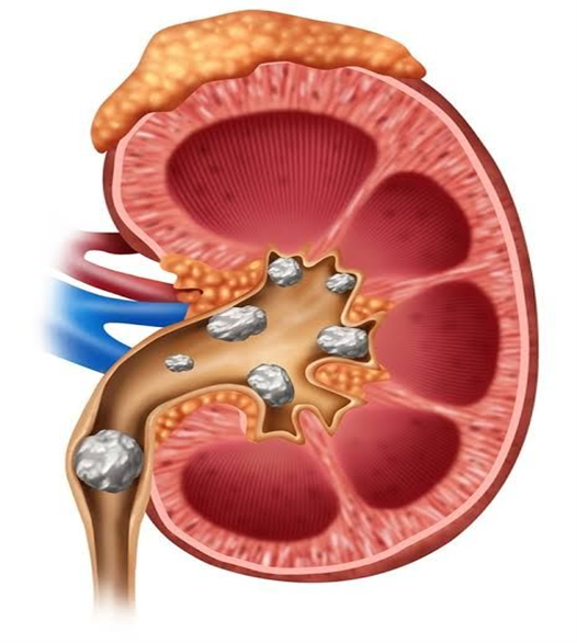 Kidney Stones: A Complete Guide from Anatomy to Treatment| HEH 2 image 2