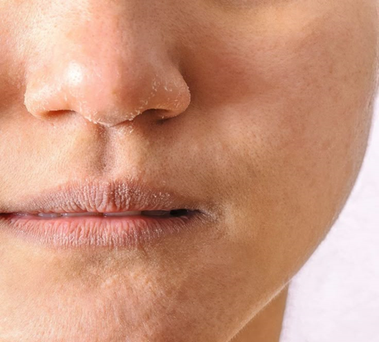 Why Your Dry Skin is not Getting Better and How to Fix it Fast?| HEH 1 image 9