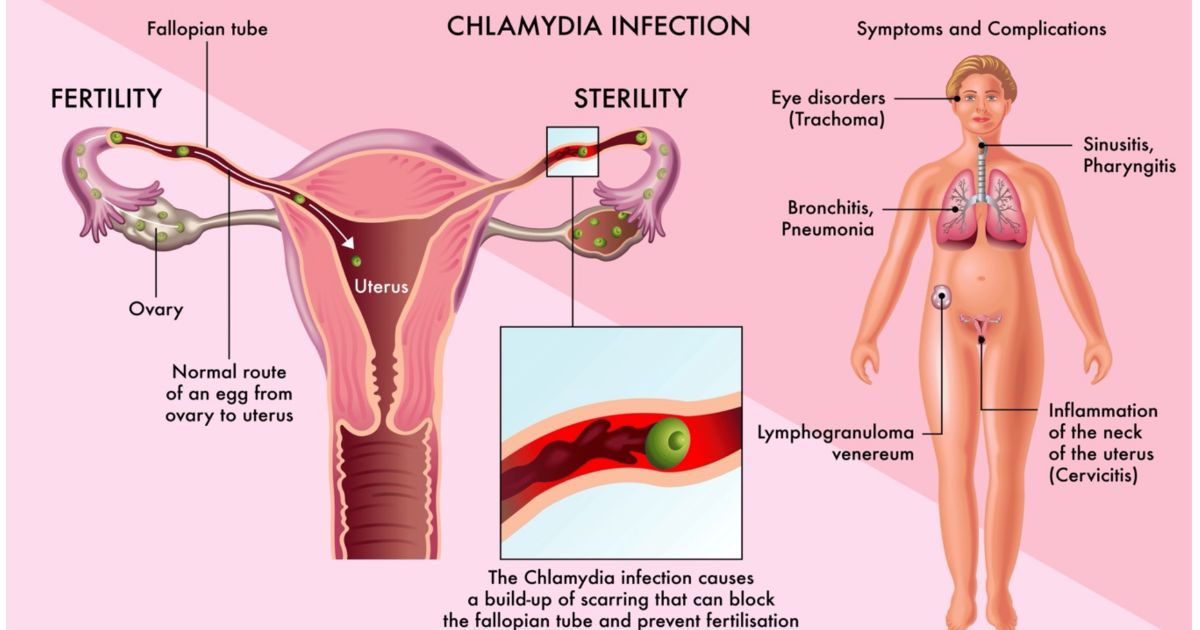 Early Symptoms of Chlamydia in Women Early Symptoms of Chlamydia in Women