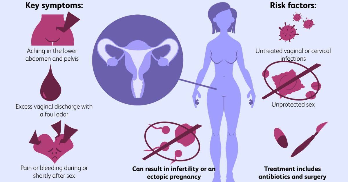 How Chlamydia Causes Pelvic Inflammatory Disease (PID) How Chlamydia Causes Pelvic Inflammatory Disease (PID)