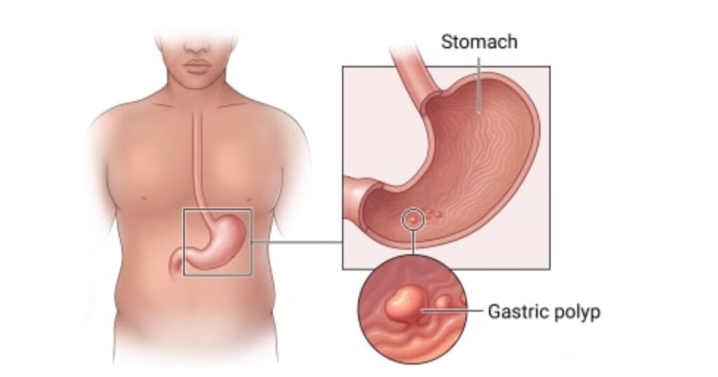 Faster Stomach Polyps Removal Recovery: Expert Diet & Lifestyle Secrets| HEH 1 Stomach Polyps