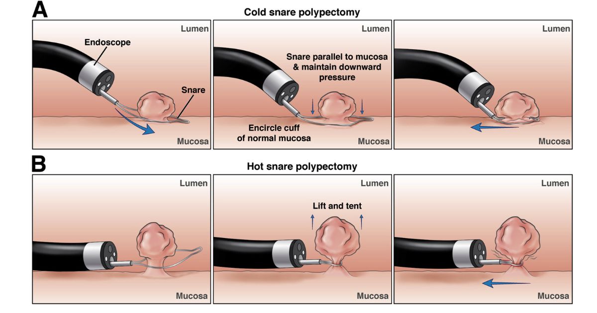 Stomach Polyp Removal Polypectomy Stomach Polyp Removal Polypectomy