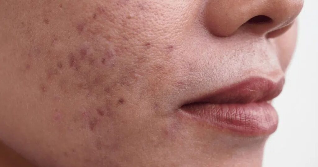 Home 6 Hyperpigmentation: Causes, Types & Treatments to Restore Clear, Radiant Skin