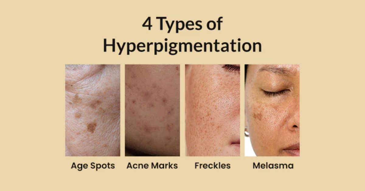 Types of Hyperpigmentation Types of Hyperpigmentation