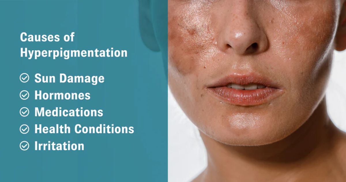 Causes of Hyperpigmentation Causes of Hyperpigmentation