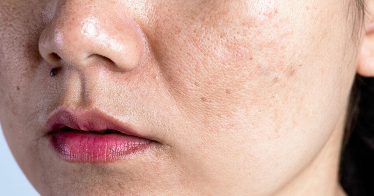 Melasma During Pregnancy Melasma During Pregnancy