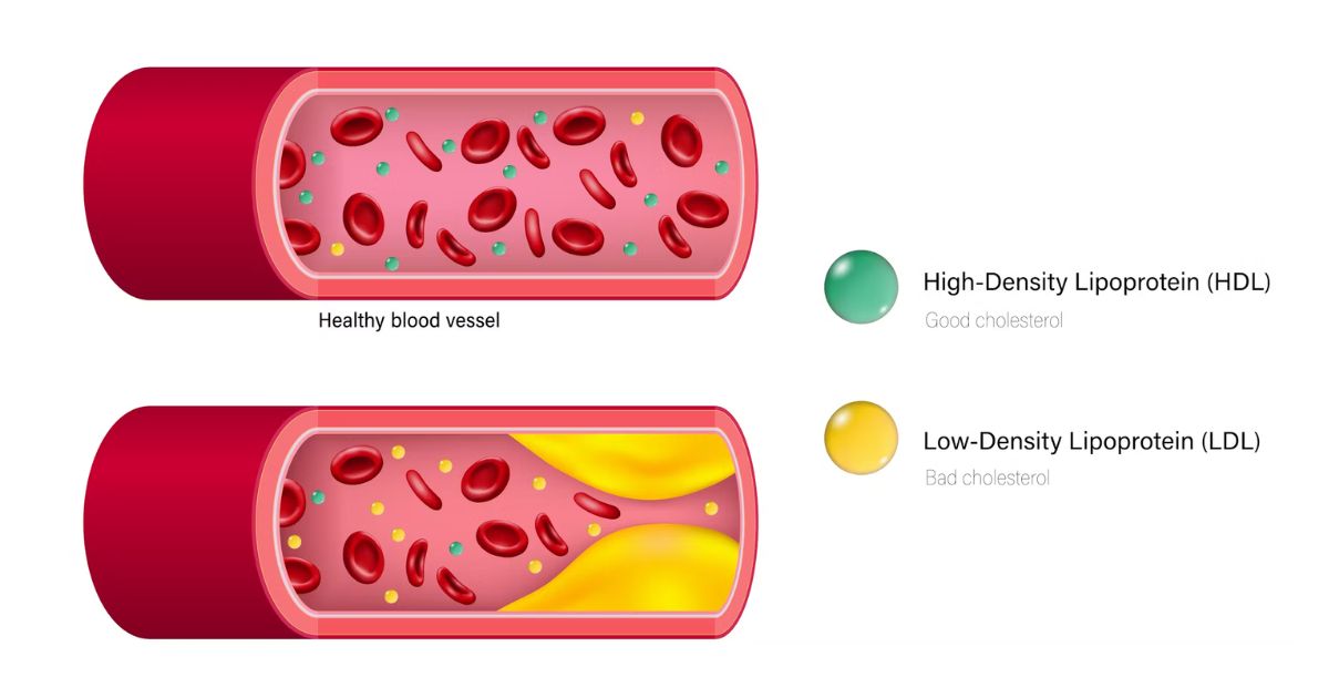 Good Cholesterol (HDL) vs. Bad Cholesterol (LDL)