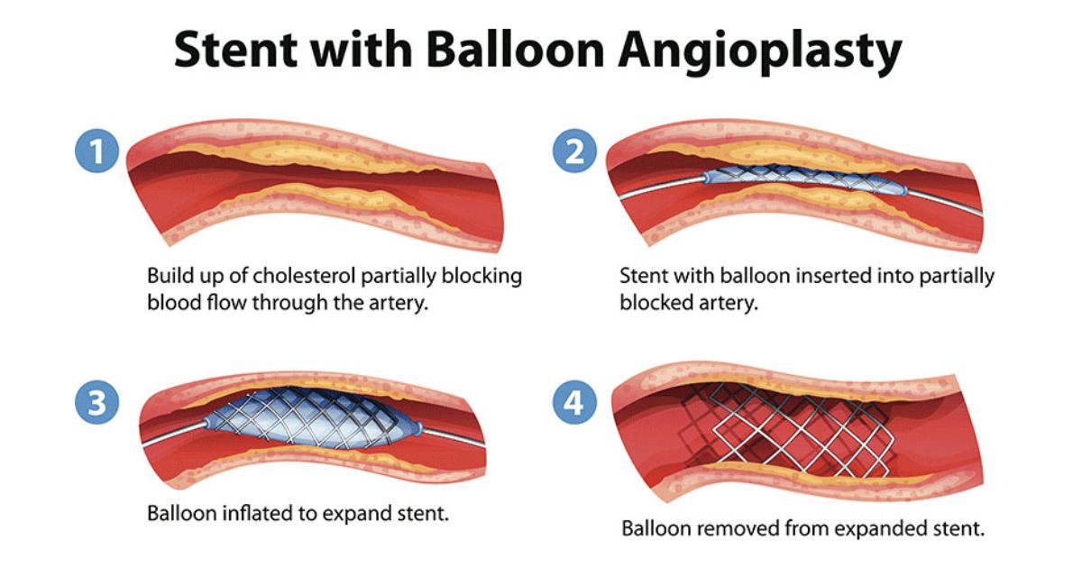 Angioplasty for Cholesterol Blockage
