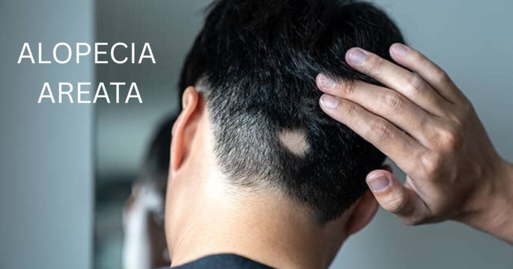 Home 1 HOW TO STOP ALOPECIA AREATA FROM SPREADING: PROFESSIONAL TRICKS AND EFFECTIVE METHODS