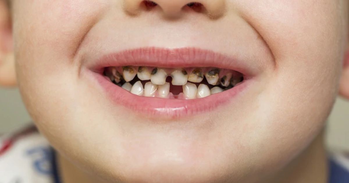 Tooth Decay (Cavities) Tooth Decay (Cavities)