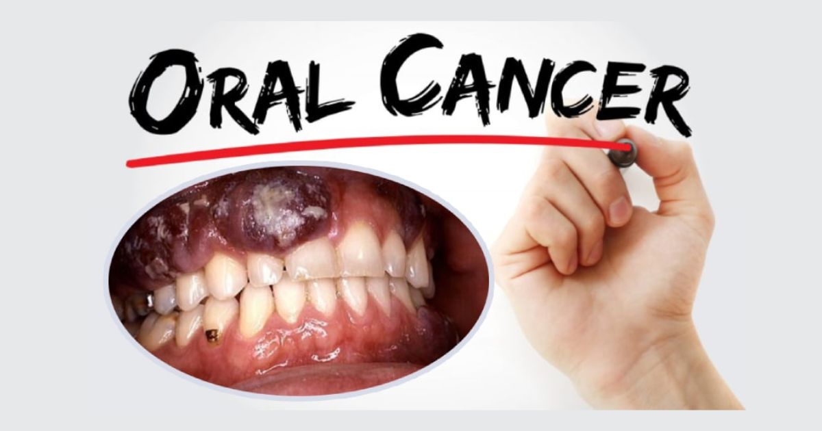 Oral Cancer: The Most Serious of the 9 Common Dental Diseases Oral Cancer: The Most Serious of the 9 Common Dental Diseases