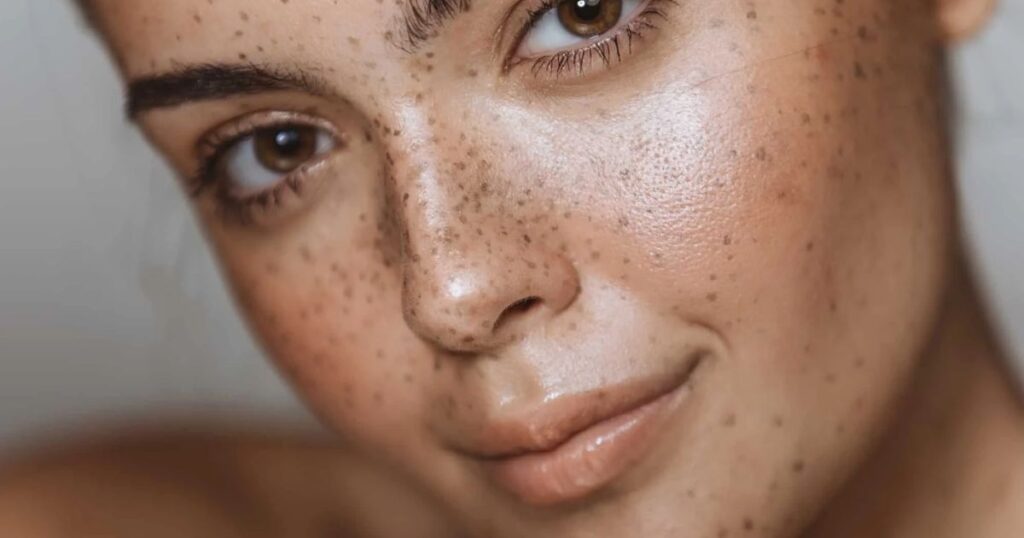 Home 5 Alpha Arbutin vs Tranexamic Acid: The Ultimate Showdown for Hyperpigmentation