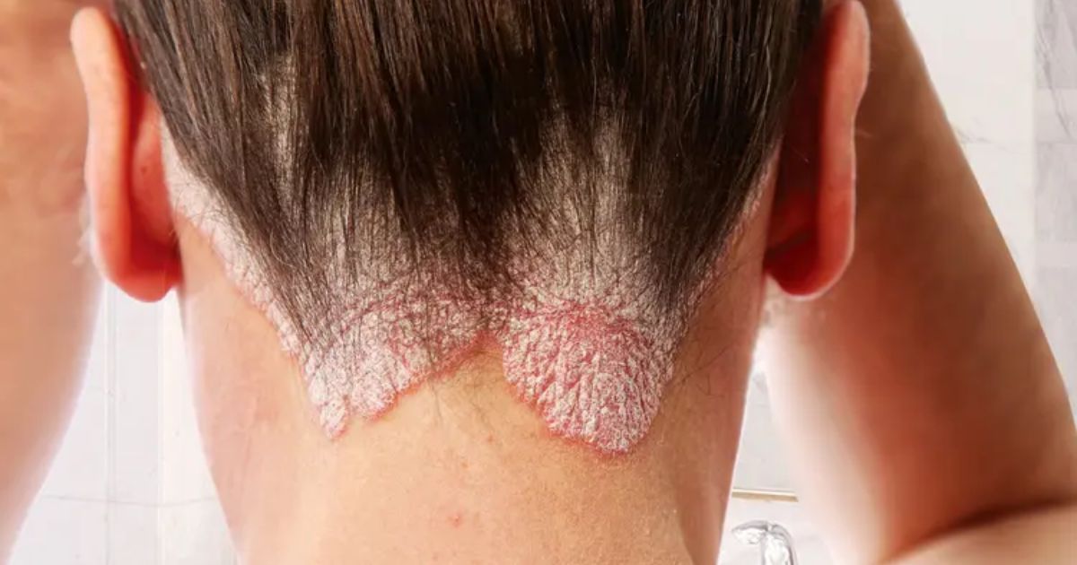 Scalp Psoriasis