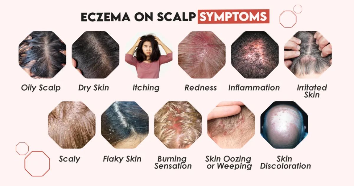 Scalp Eczema Symptoms
