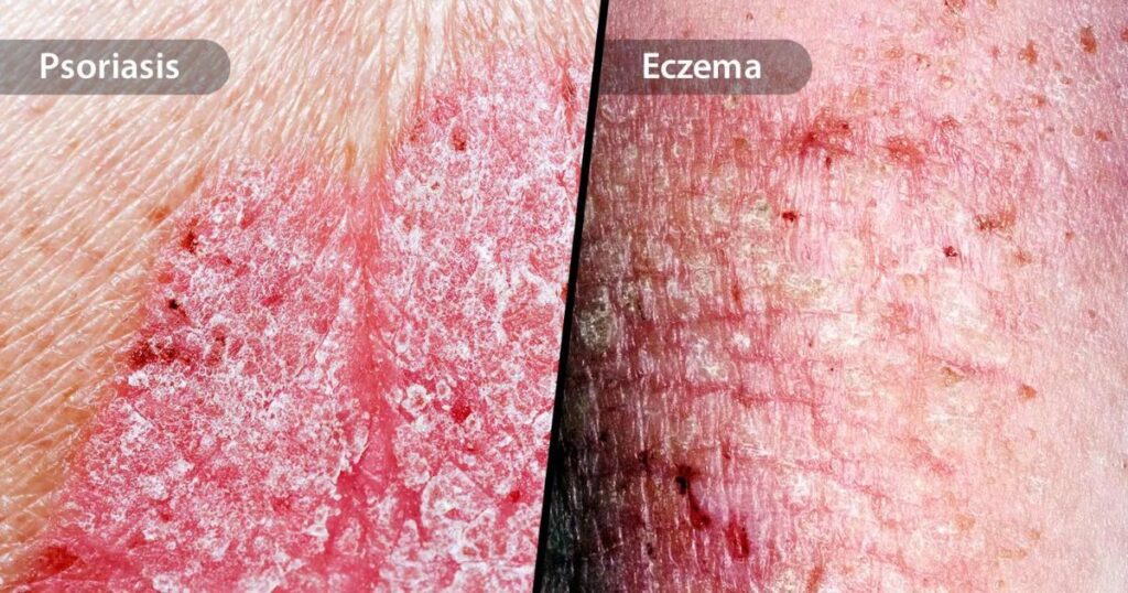 Home 3 Scalp Psoriasis vs Eczema: A Complete Guide to Symptoms, Causes, and Treatments