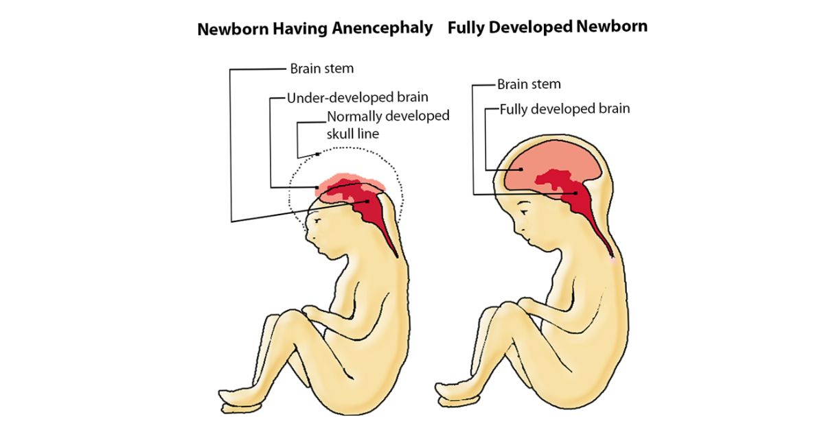 What is Anencephaly What is Anencephaly