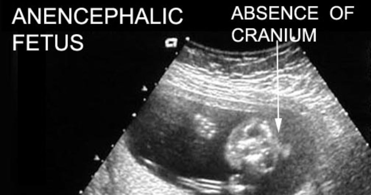 Fetal Development: How Acacia causes Anencephaly Fetal Development: How Acacia causes Anencephaly