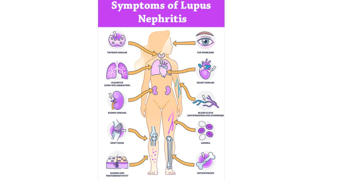 Lupus Nephritis signs and symptoms Lupus Nephritis signs and symptoms