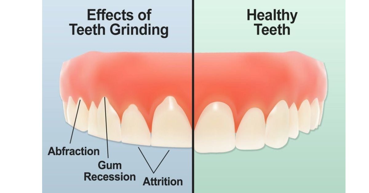 Complications of Untreated Bruxism: Reason Why You should not Underestimate It Complications of Untreated Bruxism: Reason Why You should not Underestimate It