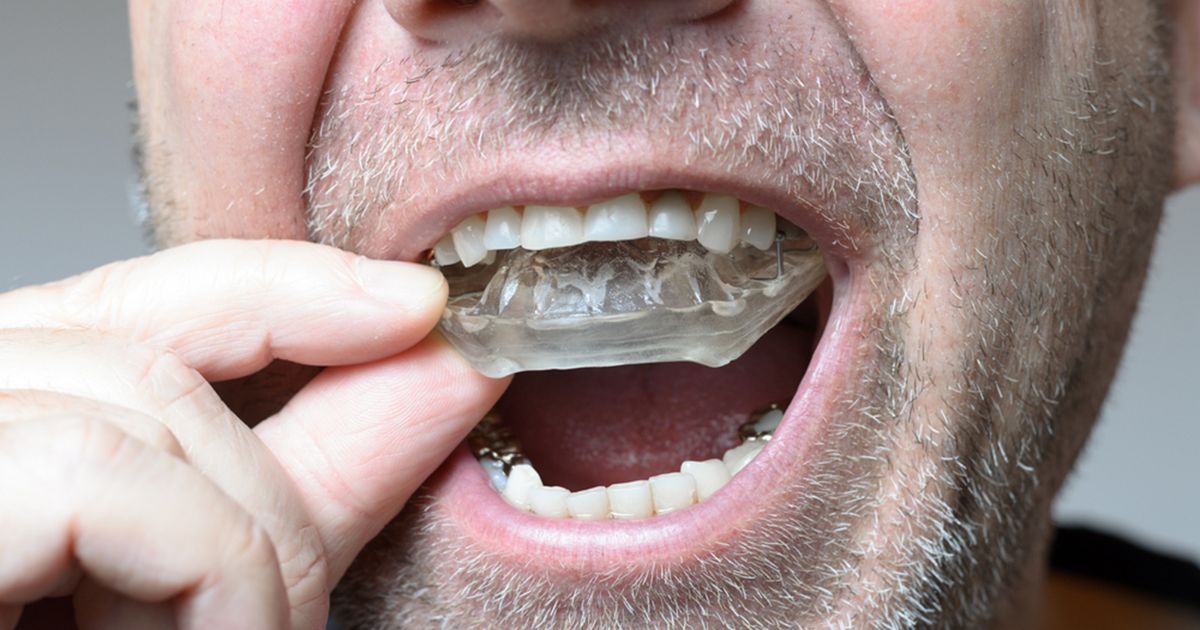 Conventional Therapies (Mouthguards, Therapy, etc.) to Teeth Grinding Conventional Therapies (Mouthguards, Therapy, etc.) to Teeth Grinding