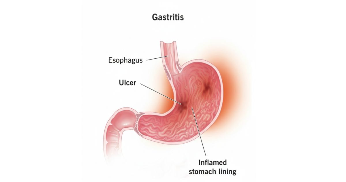 WHAT IS CHRONIC INACTIVE GASTRITIS WHAT IS CHRONIC INACTIVE GASTRITIS