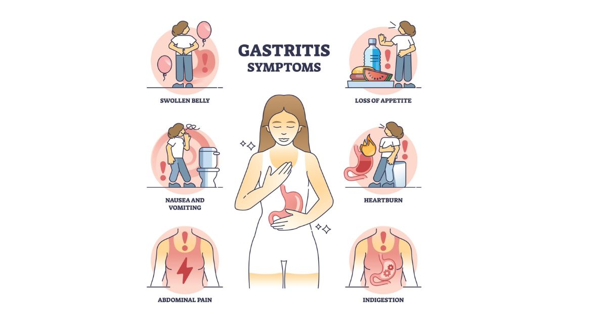 THE SIGNS AND SYMPTOMS AND EARLY WARNING OF CHRONIC INACTIVE GASTRITIS THE SIGNS AND SYMPTOMS AND EARLY WARNING OF CHRONIC INACTIVE GASTRITIS