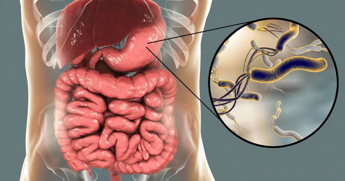HELICOBACTER PYLORI AND ITS ONSET IN CHRONIC INACTIVE GASTRITIS HELICOBACTER PYLORI AND ITS ONSET IN CHRONIC INACTIVE GASTRITIS