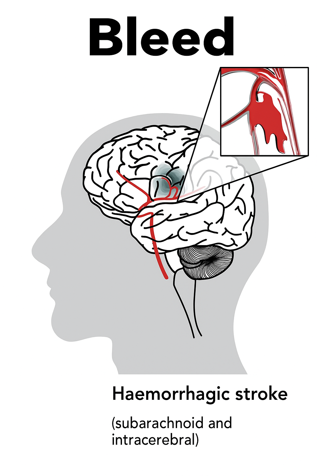 What is a Haemorrhagic Stroke? Symptoms, Risk Factors, and Care| HEH 1 haemorrhagic stroke bleed