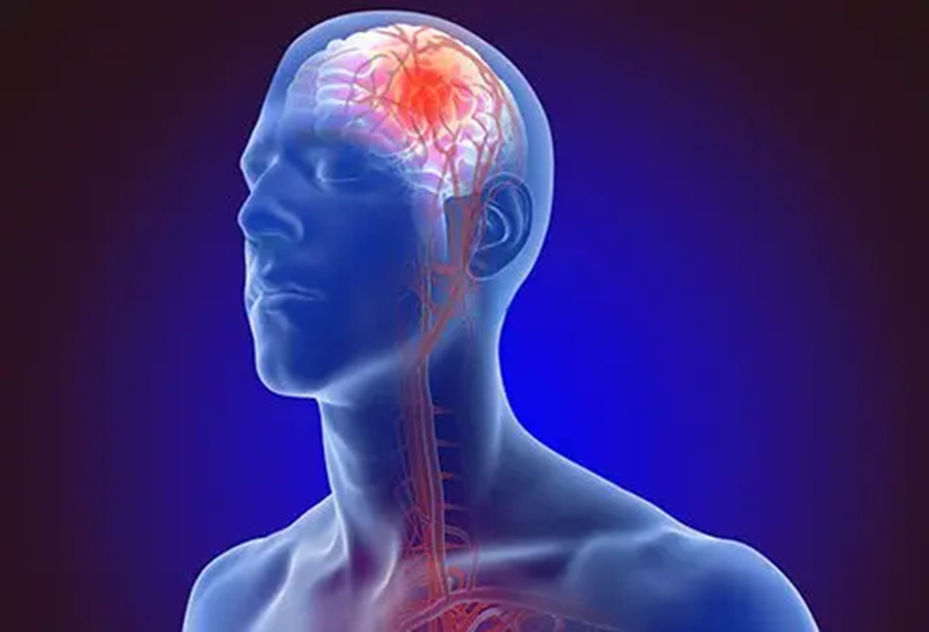 Stroke (Brain Attack): Recognize Early Signs, Causes, and Prevention Tips: HEH 1 image 11