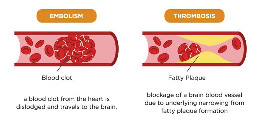 What is an Ischemic Stroke? Symptoms, Diagnosis, and Essential Treatment| HEH 2 image 13