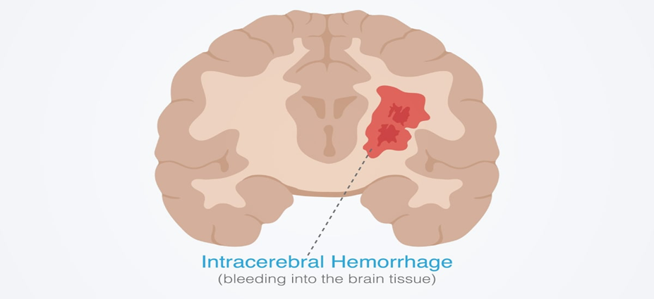 What is a Haemorrhagic Stroke? Symptoms, Risk Factors, and Care| HEH 2 image 20