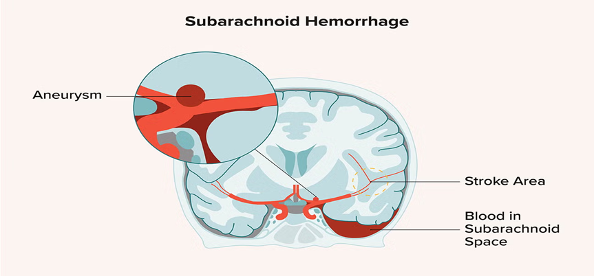 What is a Haemorrhagic Stroke? Symptoms, Risk Factors, and Care| HEH 3 image 21