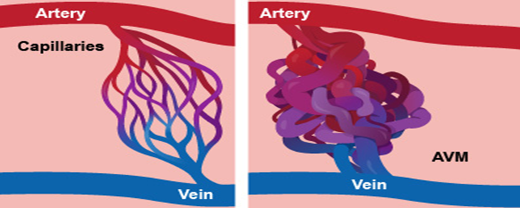 What is a Haemorrhagic Stroke? Symptoms, Risk Factors, and Care| HEH 4 image 23