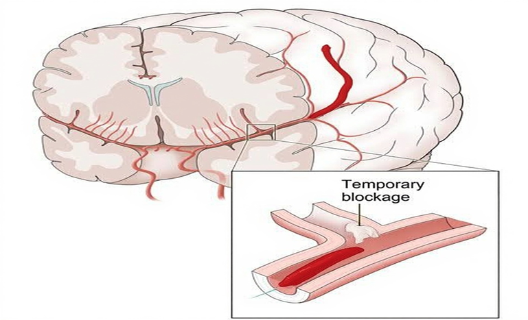 Transient Ischemic Attack: Causes, Symptoms, Diagnosis & Prevention| HEH 1 image 27