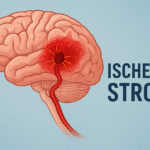 Home 8 ischemic stroke