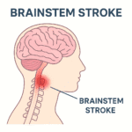 Brainstem Stroke