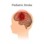 Pediatric Stroke