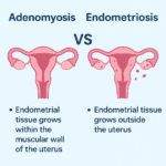 Adenomyosis vs Endometriosis