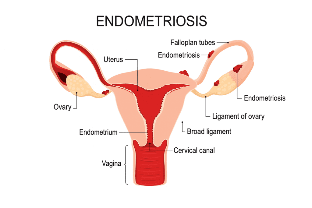 Understanding Stage 4 Endometriosis: Diagnosis, Care & Relief| HEH 1 Endometriosis