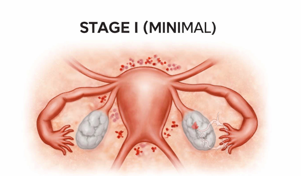Home 7 Stage 1 Endometriosis