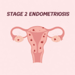 stage 2 endometriosis