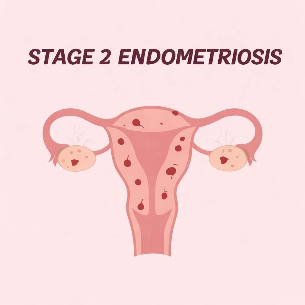 stage 2 endometriosis