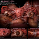 Stage 3 Endometriosis