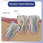 Infected Wisdom Tooth